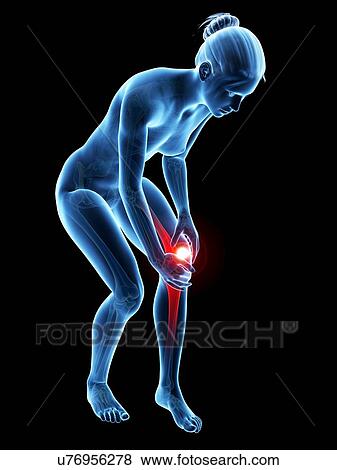 Human knee pain, illustration View Large Illustration Stock Illustration - Human knee pain, illustration. Fotosearch