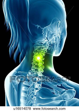 Human neck bones, illustration View Large Illustration Stock Illustration - Human neck bones, illustration. Fotosearch