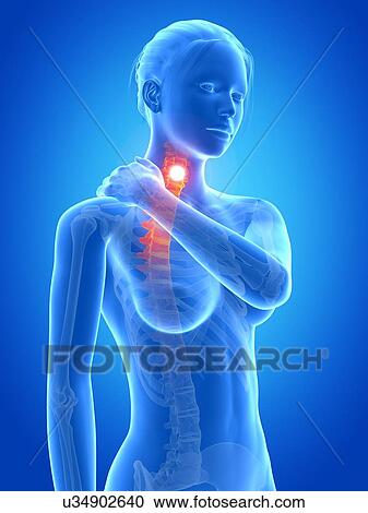 Human neck pain, illustration View Large Illustration Clipart - Human neck pain, illustration. Fotosearch