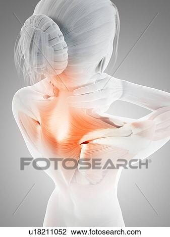 Drawing - Human neck pain, illustration. Fotosearch