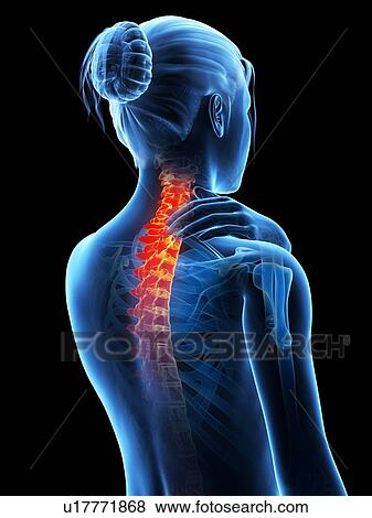 Stock Illustration - Human neck pain, illustration. Fotosearch