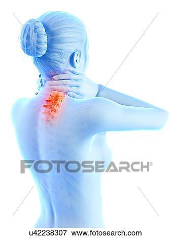 Stock Illustration - Human neck pain, illustration. Fotosearch