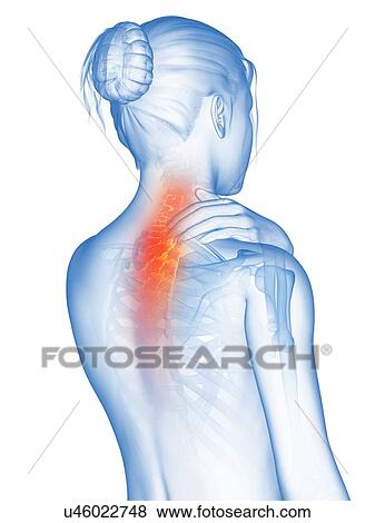 Human neck pain, illustration View Large Illustration Stock Illustration - Human neck pain, illustration. Fotosearch