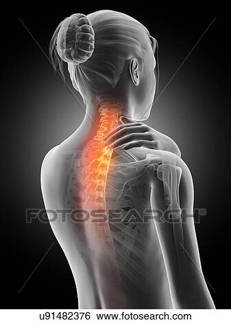 Stock Illustration - Human neck pain, illustration. Fotosearch