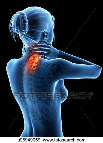 Stock Illustration - Human neck pain, illustration. Fotosearch