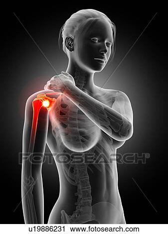 Clip Art - Human shoulder pain, illustration. Fotosearch