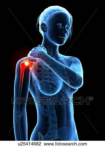 Drawing - Human shoulder pain, illustration. Fotosearch