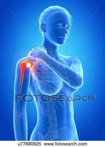 Stock Illustration - Human shoulder pain, illustration. Fotosearch