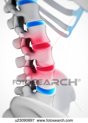 Stock Illustration - Human spinal discs, illustration. Fotosearch