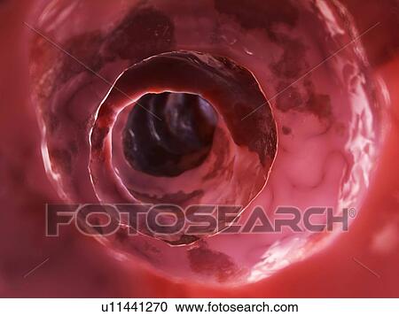 Clipart - Inflamed colon, illustration. Fotosearch