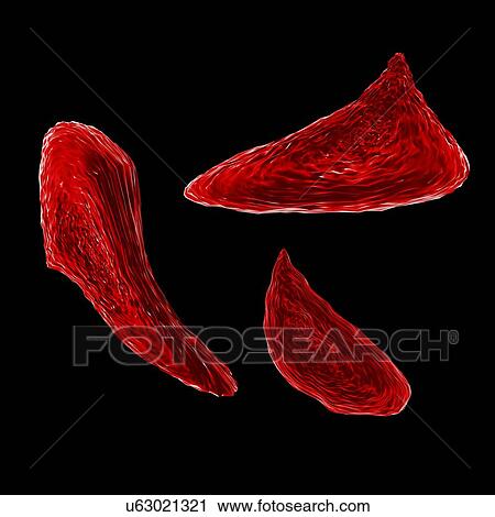 Sickle cell anaemia, illustration View Large Illustration Clip Art - Sickle cell anaemia, illustration. Fotosearch