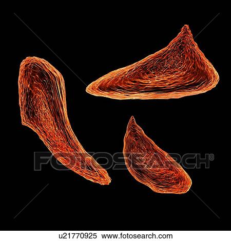 Sickle cell anaemia, illustration View Large Illustration Stock Illustration - Sickle cell anaemia, illustration. Fotosearch