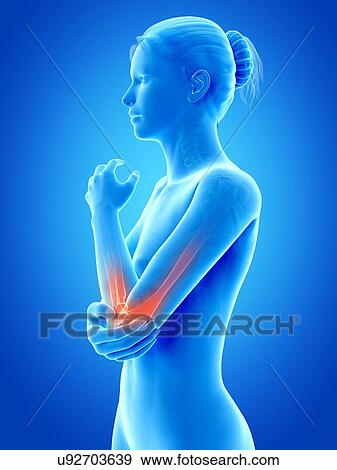 Elbow pain, illustration View Large Illustration Stock Illustration - Elbow pain, illustration. Fotosearch