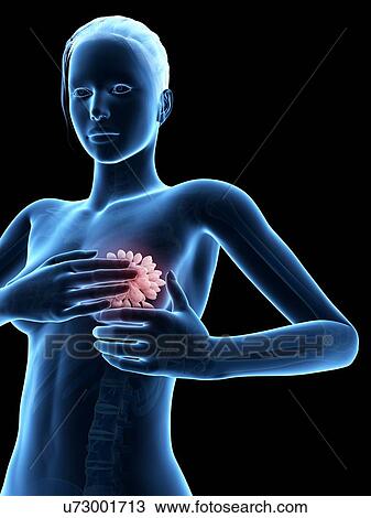 Drawing - Female breast examination, illustration. Fotosearch