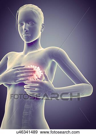 Stock Illustration - Female breast examination, illustration. Fotosearch