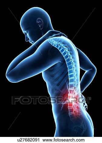 Clip Art - Human back pain, illustration. Fotosearch