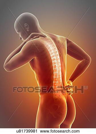Clip Art - Human back pain, illustration. Fotosearch