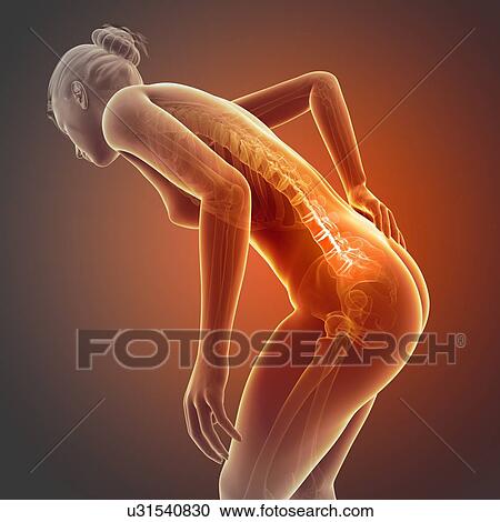 Clipart - Human back pain, illustration. Fotosearch