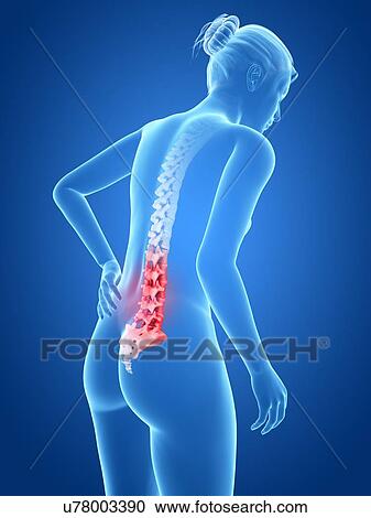 Clipart - Human back pain, illustration. Fotosearch