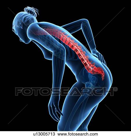 Drawing - Human back pain, illustration. Fotosearch