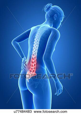 Drawing - Human back pain, illustration. Fotosearch