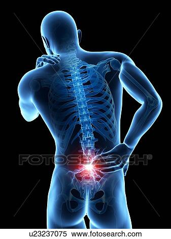 Stock Illustration - Human back pain, illustration. Fotosearch