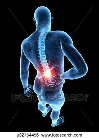 Stock Illustration - Human back pain, illustration. Fotosearch
