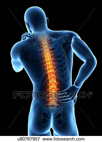 Stock Illustration - Human back pain, illustration. Fotosearch