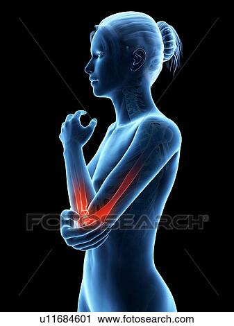 Clip Art - Human elbow joint pain, illustration. Fotosearch