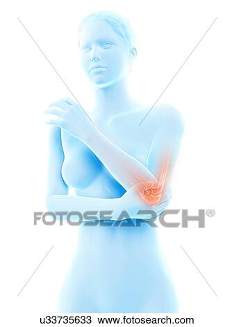 Drawing - Human elbow joint pain, illustration. Fotosearch