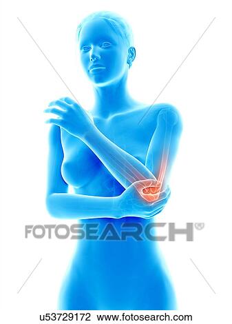 Drawing - Human elbow joint pain, illustration. Fotosearch