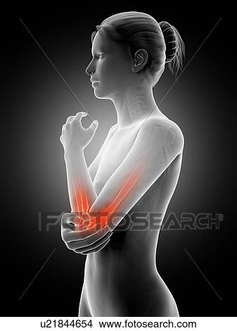 Stock Illustration - Human elbow joint pain, illustration. Fotosearch
