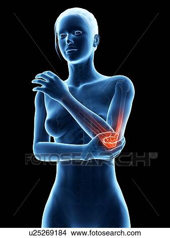 Human elbow joint pain, illustration View Large Illustration Stock Illustration - Human elbow joint pain, illustration. Fotosearch