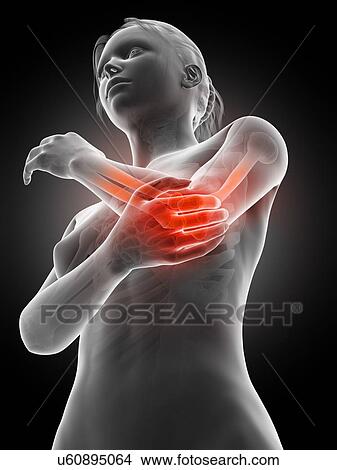 Stock Illustration - Human elbow joint pain, illustration. Fotosearch
