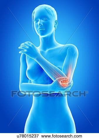 Stock Illustration - Human elbow joint pain, illustration. Fotosearch
