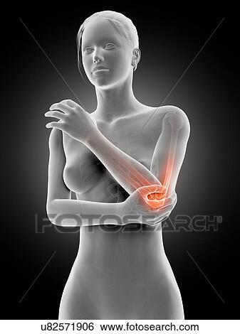 Stock Illustration - Human elbow joint pain, illustration. Fotosearch