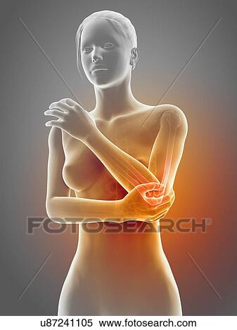 Human elbow joint pain, illustration View Large Illustration Stock Illustration - Human elbow joint pain, illustration. Fotosearch