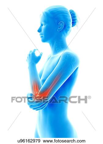 Stock Illustration - Human elbow joint pain, illustration. Fotosearch