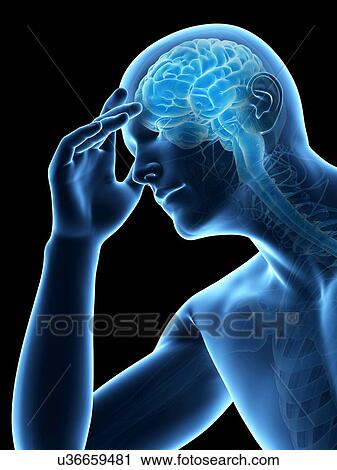 Clip Art - Human headache, illustration. Fotosearch