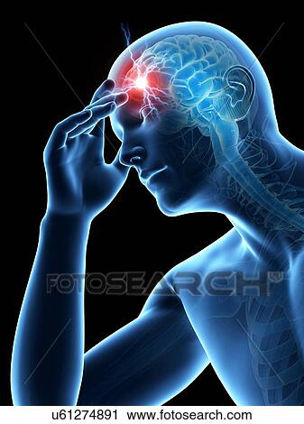 Clip Art - Human headache, illustration. Fotosearch