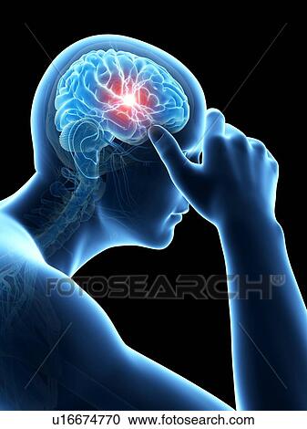 Clipart - Human headache, illustration. Fotosearch