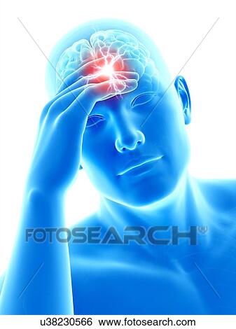 Stock Illustration - Human headache, illustration. Fotosearch