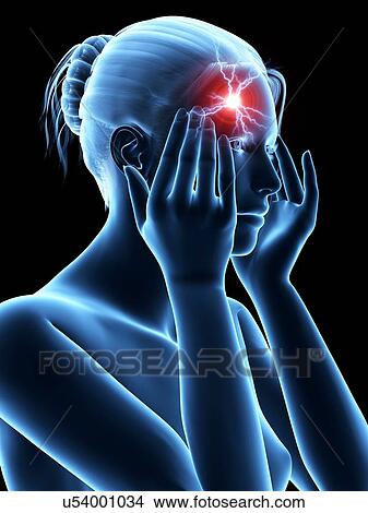 Stock Illustration - Human headache, illustration. Fotosearch