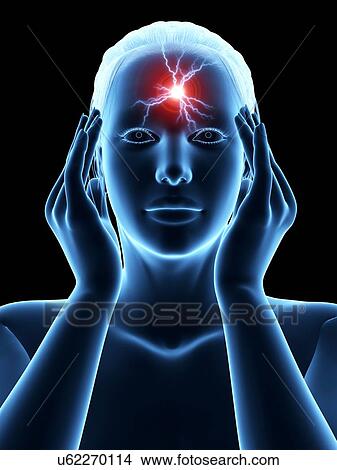 Stock Illustration - Human headache, illustration. Fotosearch