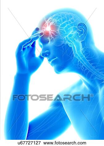 Stock Illustration - Human headache, illustration. Fotosearch