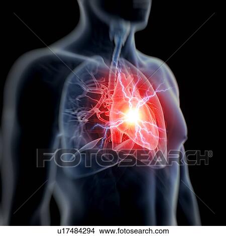 Human heart attack, illustration View Large Illustration Stock Illustration - Human heart attack, illustration. Fotosearch