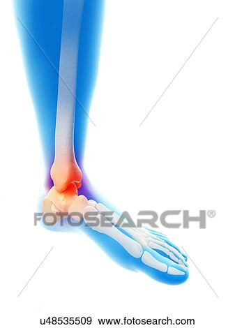 Stock Illustration - Human inflamed ankle, illustration. Fotosearch