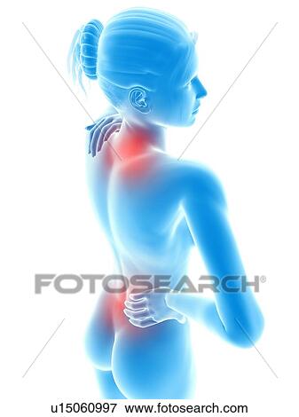 Stock Illustration - Human neck and back pain, illustration. Fotosearch