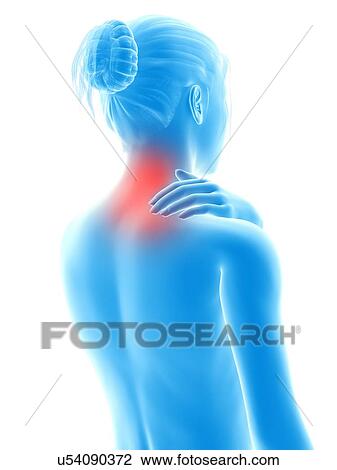 Drawing - Human neck pain, illustration. Fotosearch