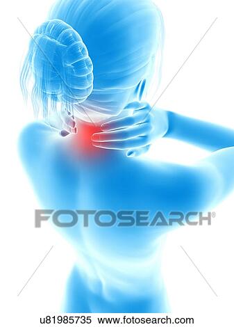 Stock Illustration - Human neck pain, illustration. Fotosearch